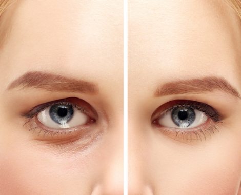 Lower-Eyelid Blepharoplasty.Asian Eyelid Surgery.Upper blepharoplasty.Correcting  the aging process